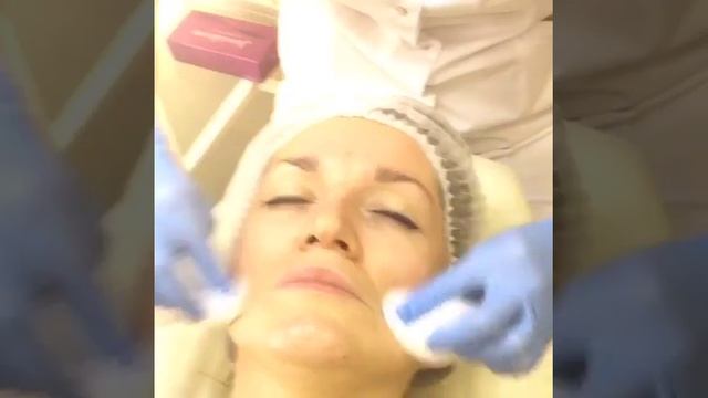 Миндальный пилинг смотреть онлайн