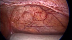 Рецидив паховой грыжи после двусторонней E - TEP пластики.