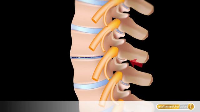 Spondylose der Wirbelsäule mit Schäden an Facettengelenken und Bandscheiben смотреть онлайн