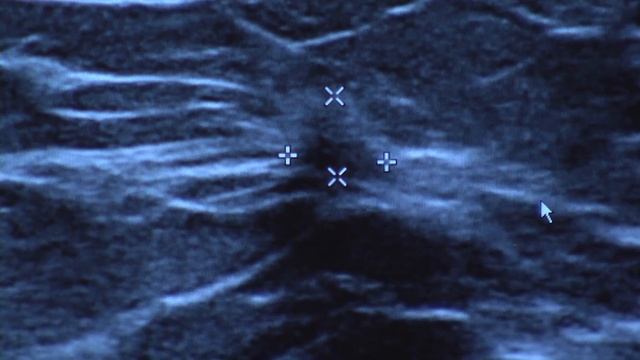 Cancer Treatment Without Chemo (Emily Albright, MD) смотреть онлайн
