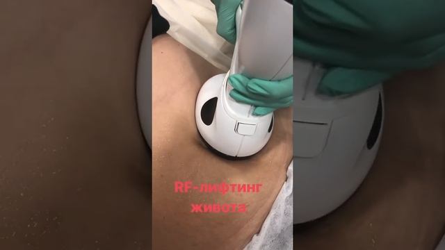 RF-лифтинг живота смотреть онлайн