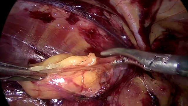 ETEP For Left Inguinal Hernia Repair.