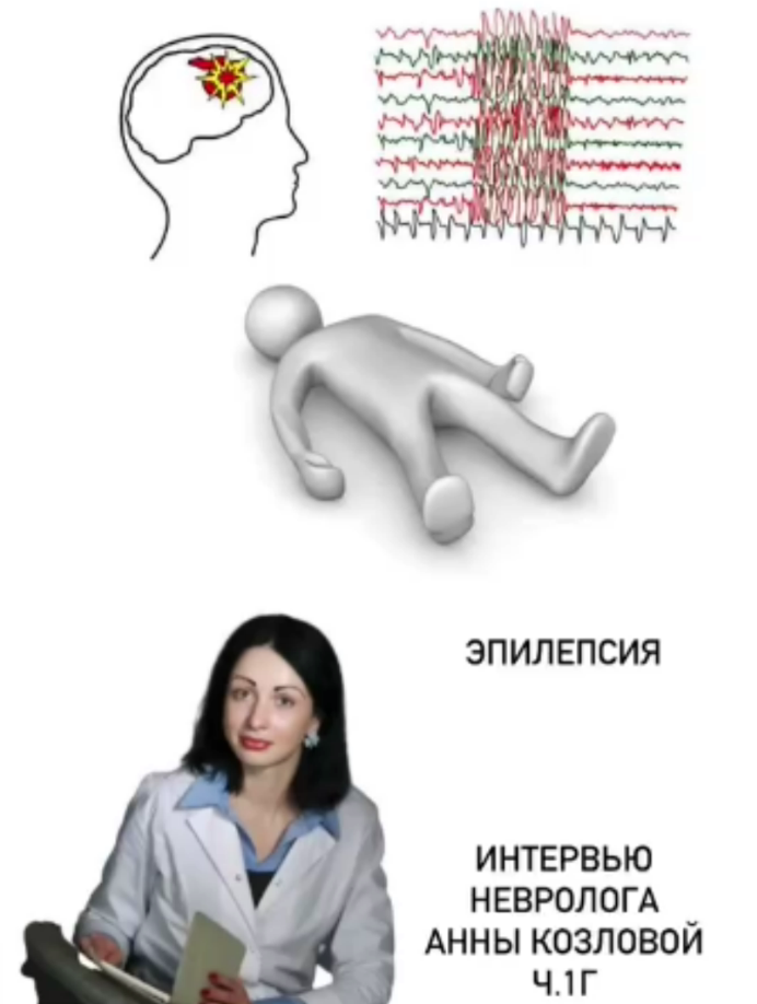 Эпилепсия.