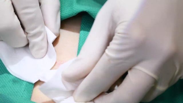 Draining a Pilonidal Cyst on the Gluteal Cleft - Max Poling PA-C | oceandriveplasticsurgery.com смотреть онлайн