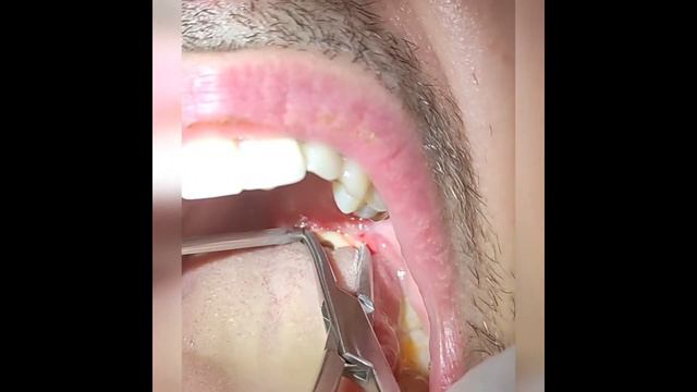 Drenaje de ABSCESO periamigdalino con salida de ABUNDANTE PUS смотреть онлайн