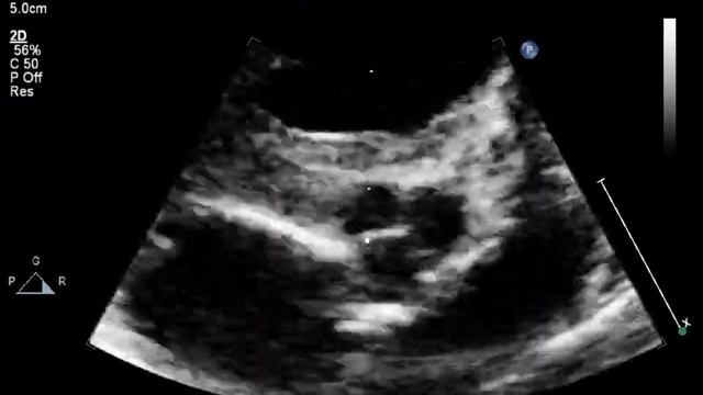 Эхо КГ с анализом стеноза легочной артерии (рус. перевод)