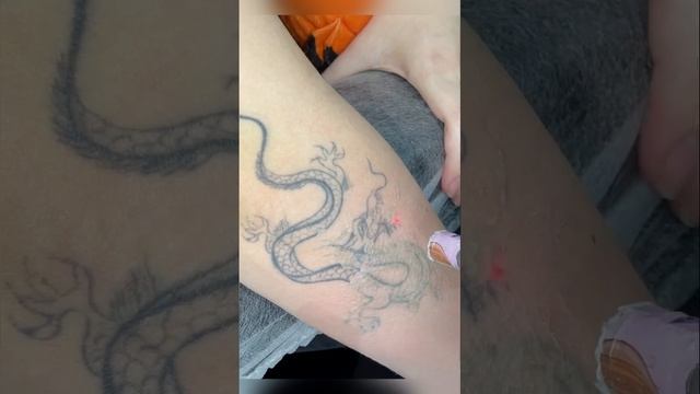 Лазерное удаление татуировок в Москве #removetattoo #laser #tattoo #tattooremove смотреть онлайн