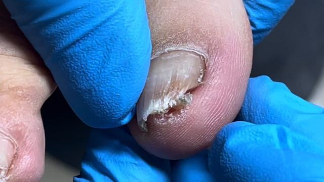Nails That Curl Inward Are Too Painful To Trim【Pedicure Master Lin Jun】