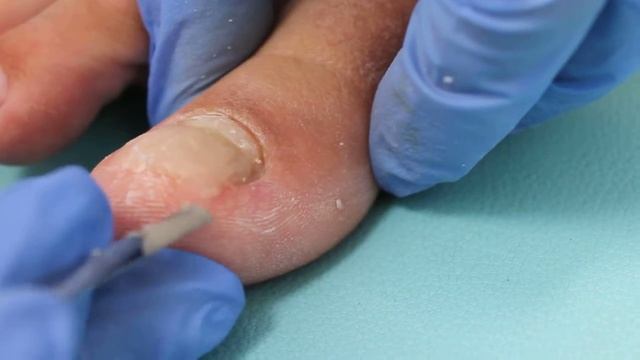 Изготовление протеза смотреть онлайн