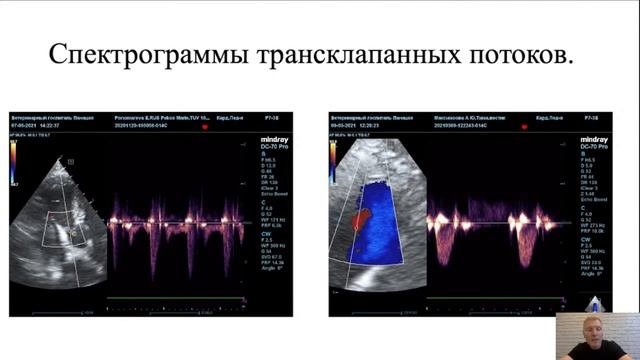 Допплерографическая оценка трансклапанных потоков смотреть онлайн