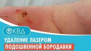 ✅ Удаление лазером подошвенной бородавки. Клинический случай №262