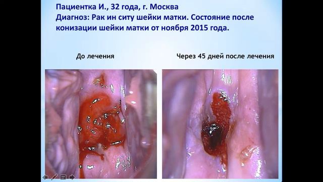 Рак in situ смотреть онлайн