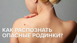 Как распознать опасные родинки?