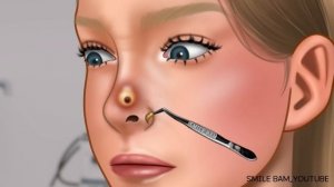 ASMR 피어싱 후에 관리가 꼭 필요한 이유! 피어싱 고름 제거하기 | 코 왕 여드름 짜기 | Remove unmanaged piercing pus