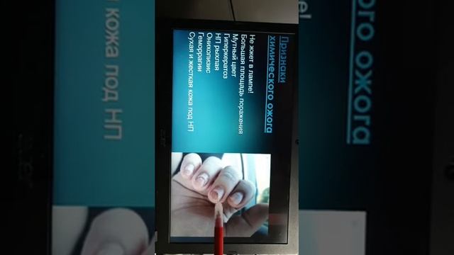 Термический и химический ожог НП смотреть онлайн