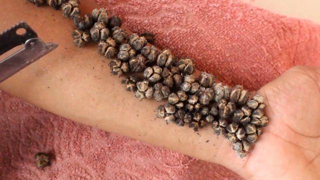 We Help Cleaning Million Big Ticks on Hand Man With Knife That Work 100% #221 смотреть онлайн