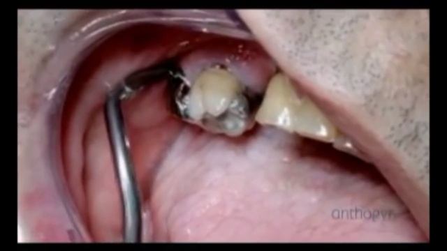 Как снять керамическую коронку или мост с зубов не разрезая его. Стоматологическое оборудование смотреть онлайн