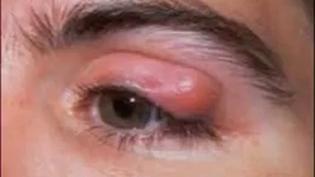 Халязион смотреть онлайн