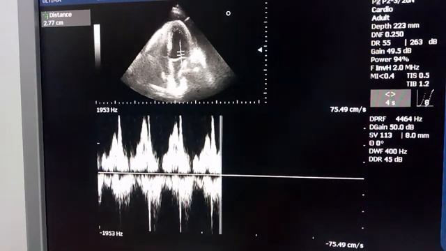Тампонада сердца при онкологическом заболевании смотреть онлайн