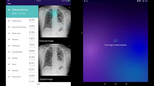 Mobile Chest X-Ray Analysis, a Microsoft Garage project | The Xamarin Show смотреть онлайн