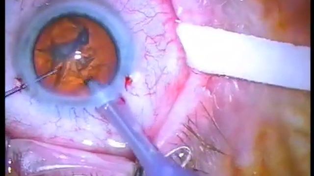 ACRILISA Multifocal Lens Implant смотреть онлайн