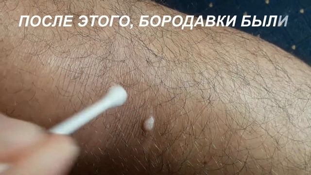 Как удалить бородавки (замедленное видео) смотреть онлайн
