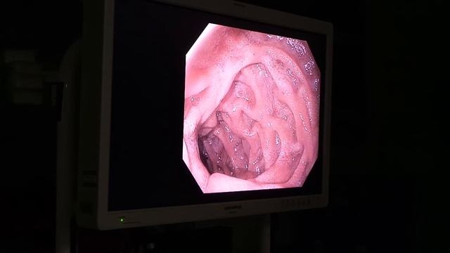 Upper GI Endoscopy Procedure in the ED смотреть онлайн