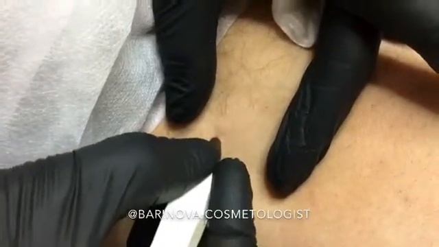 Удаление папиллом! смотреть онлайн