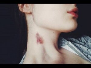 КАК БЫСТРО Избавиться от ЗАСОСА/СИНЯКА?✔Elena Matveeva