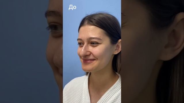 До и после ринопластики. смотреть онлайн