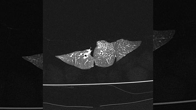 CT Scan human lung 1 day смотреть онлайн