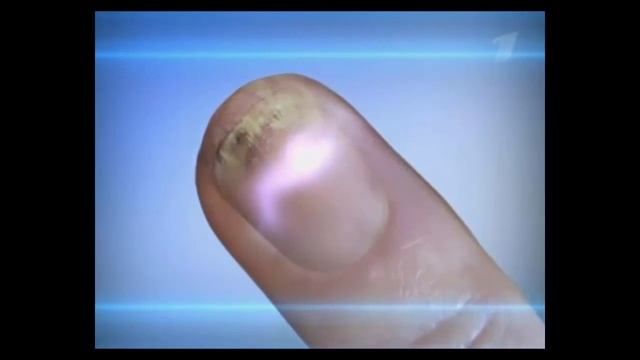 Действие ирунина на ногти