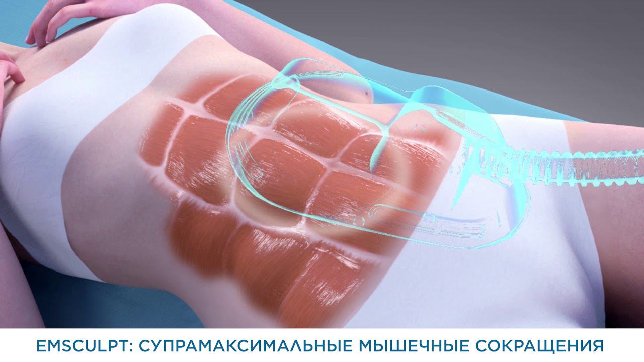 Emsculpt смотреть онлайн