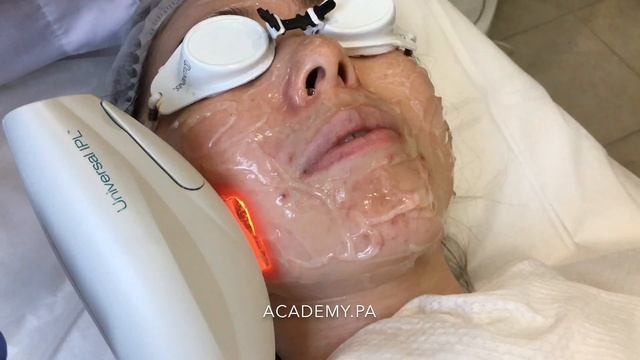 С аппаратом М22 - забываем о сосудистой сетке, пигментации, постакне. 28.09.2018. смотреть онлайн