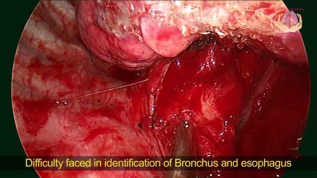 Interesting Case of Mediastinal Lymphadenopathy Biopsy | Thoracoscopic Surgery смотреть онлайн