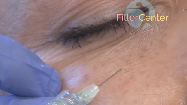 инъекции Erelle Total Action и Erelle Volume смотреть онлайн