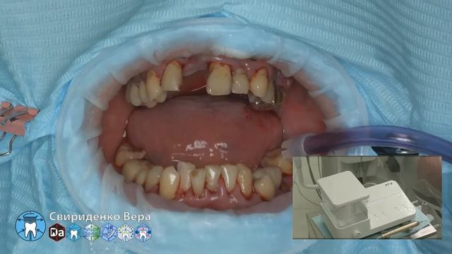 Professional oral hygiene -case 008 Acteon DTE Dentsply Coxo Floweis 3M KerrHawe (FHD multistream) смотреть онлайн