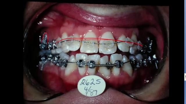 Class 3 Non Surgical Correcton Case 1 смотреть онлайн