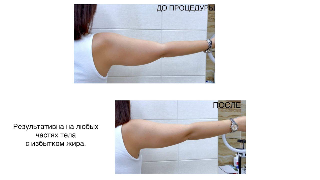 #СМАСлифтинг на аппарате Liftera: эффективное #похудение смотреть онлайн