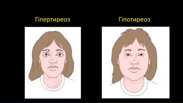 ЕНДОКРИННІ РОЗЛАДИ смотреть онлайн