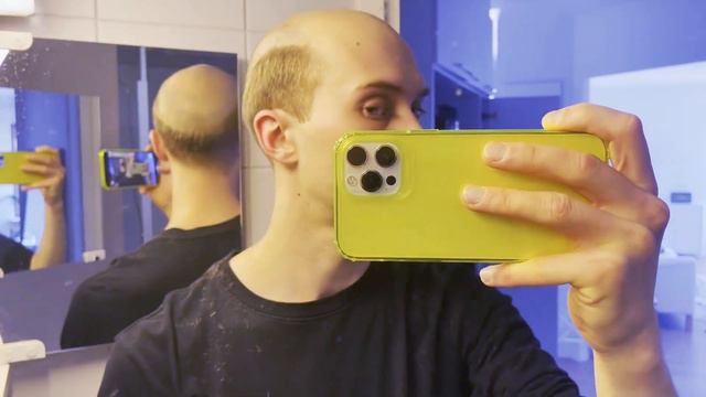 Hair System DIY: Cleaning and Preparing the Scalp Before Reattaching a Poly Hair System | Lordhair смотреть онлайн