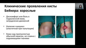 #УЗИ  заднего отдела коленного сустава. Киста Бейкера.