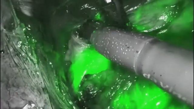 DaVinci X Robot Firefly Sentinel Node Identification Endmetrial Carcinoma смотреть онлайн