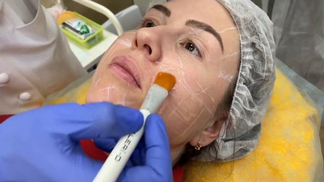 Ультразвуковой SMAS-лифтинг на аппарате Ultraformer III смотреть онлайн