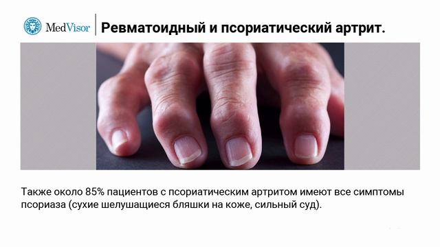 Ревматоидный и псориатический артрит в чем отличия؟ смотреть онлайн