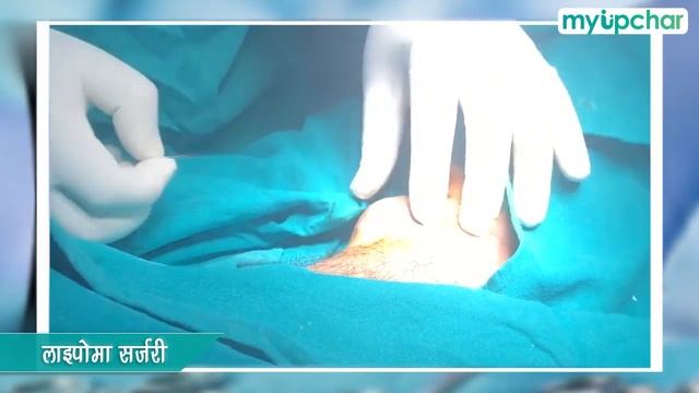 हो गया है लाइपोमा? जानें लाइपोमा (चर्बी की गांठ) का इलाज व कारण, देखें सर्जरी | Lipoma in Hindi смотреть онлайн