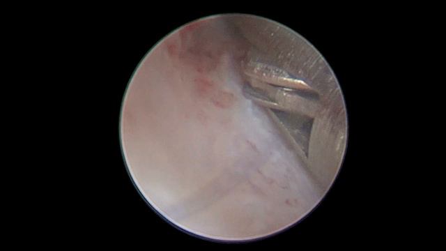 Synechia Of The Cervical Canal. Surprise. Синехии в цервикальном канале. Сюрприз.