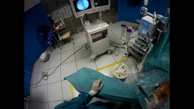 Vésicule coelio vue externe (Laparoscopic cholecystectomy: outer view) смотреть онлайн