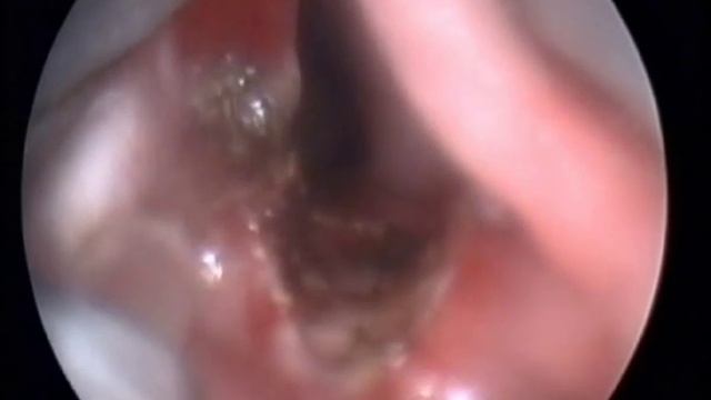 Laser surgery in ENT / Лазерная хирургия в оториноларингологии смотреть онлайн