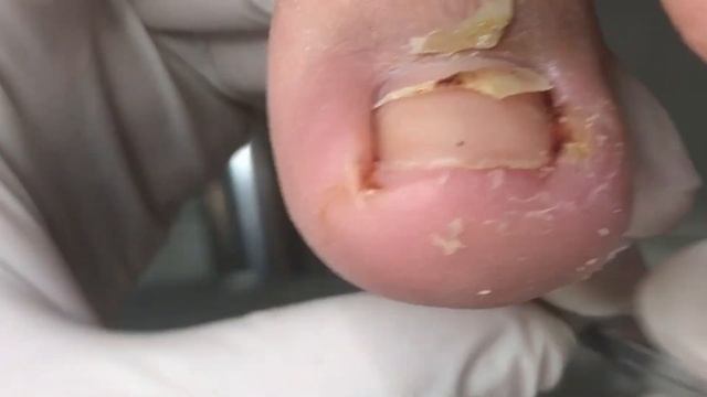 Trim Paronychia For Patients! Professional Pedicure【Crazy Pedicure Room】